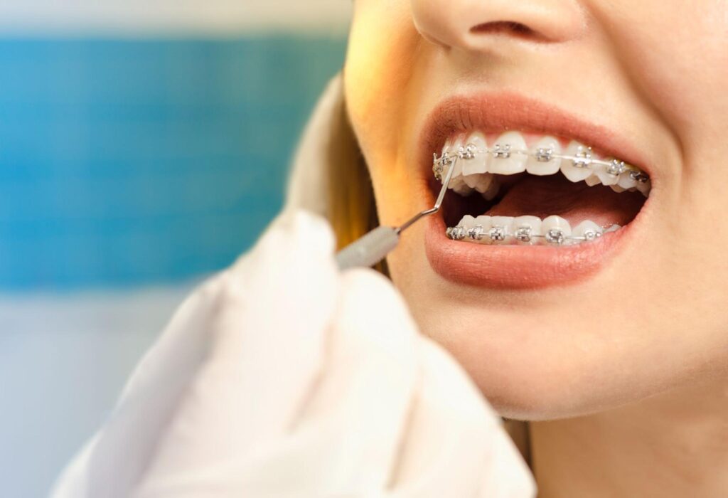 How Long Does Orthodontic Treatment Take?