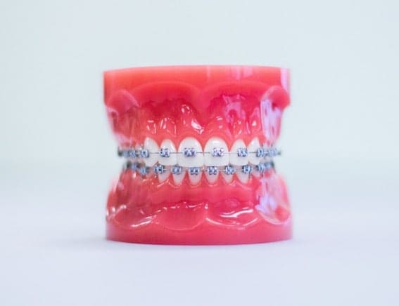 Queensbury Orthodontics metal braces